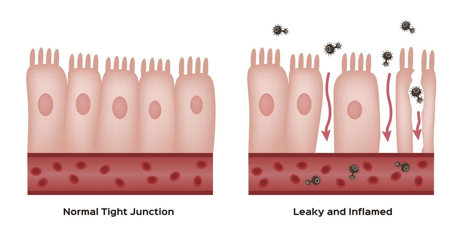 graphic-of-the-inner-walls-of-the-gut-showing-normal-tight-junctions-and-a-leaky-gut-side-by-side